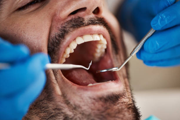 Best Emergency Wisdom Teeth Removal in Halesite, NY