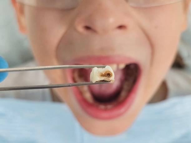 Best Emergency Tooth Extraction in Halesite, NY